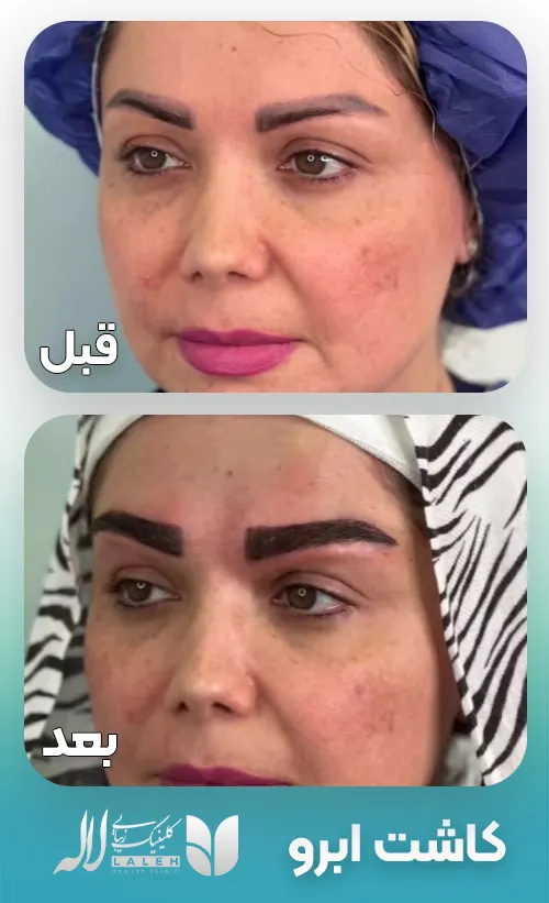 کاشت ابرو در لاله