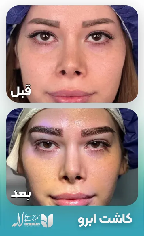 قبل بعد کاشت ابرو