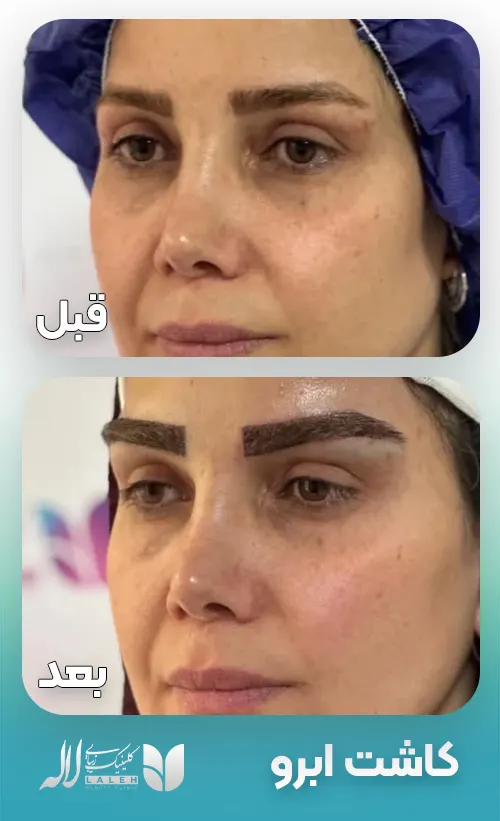 کاشت ابرو