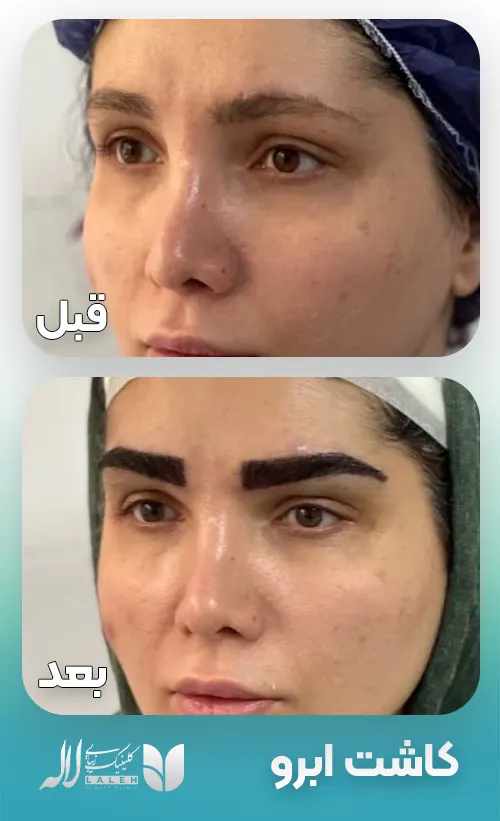 کاشت ابرو قبل بعد