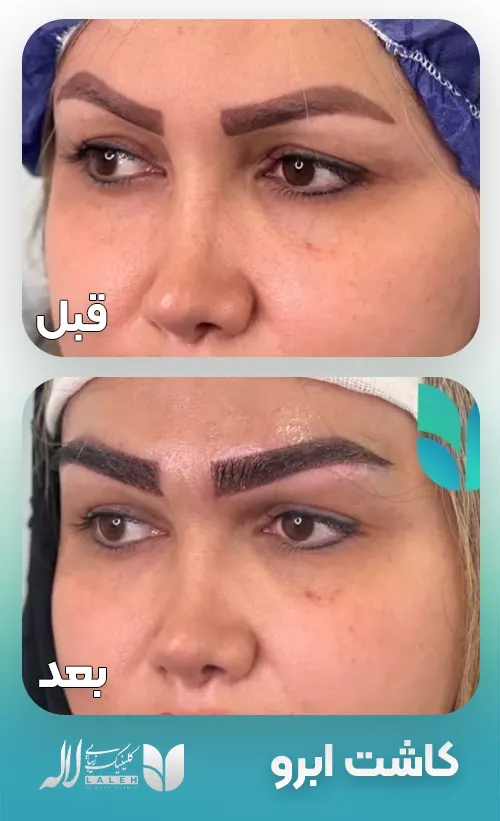 کاشت ابرو قبل بعد