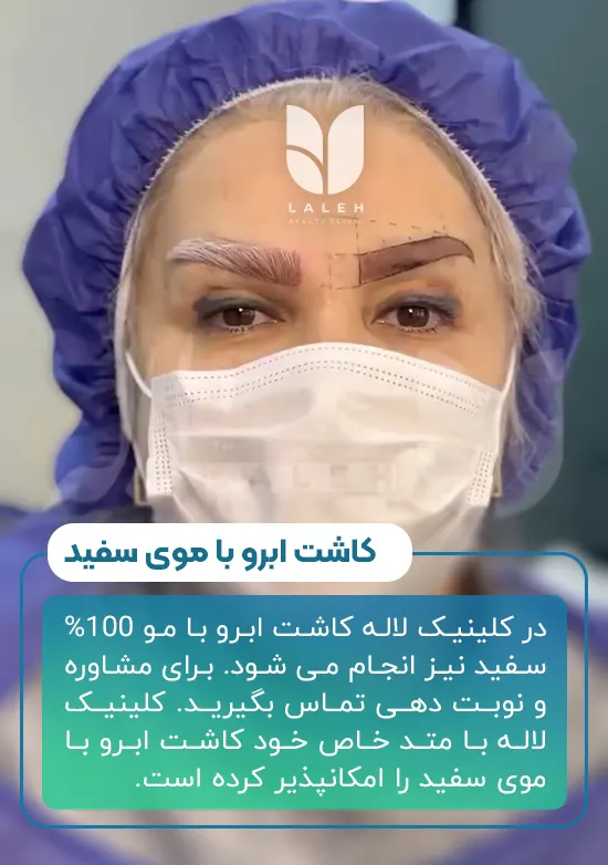 کاشت ابرو با موی سفید