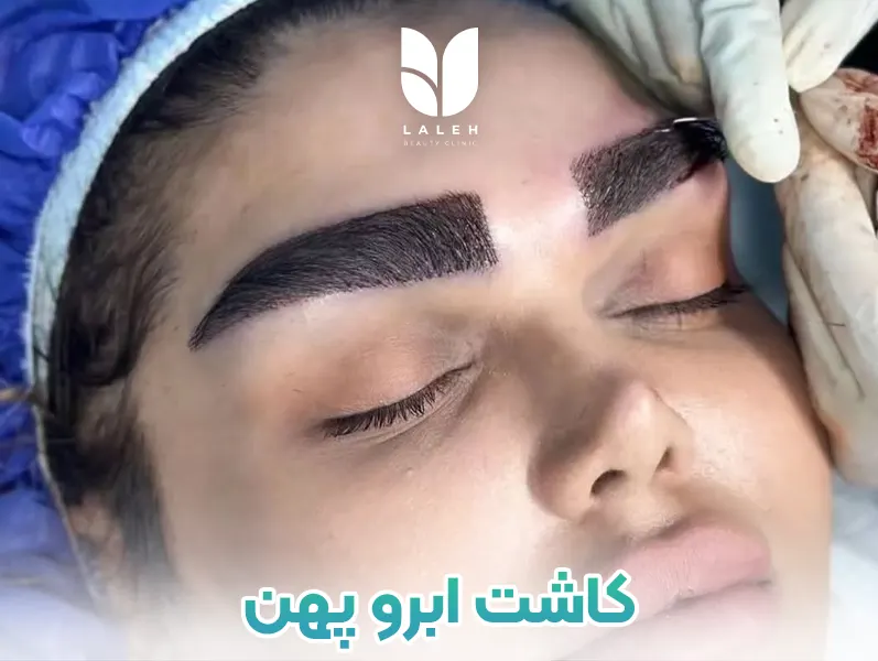 کاشت ابرو پهن