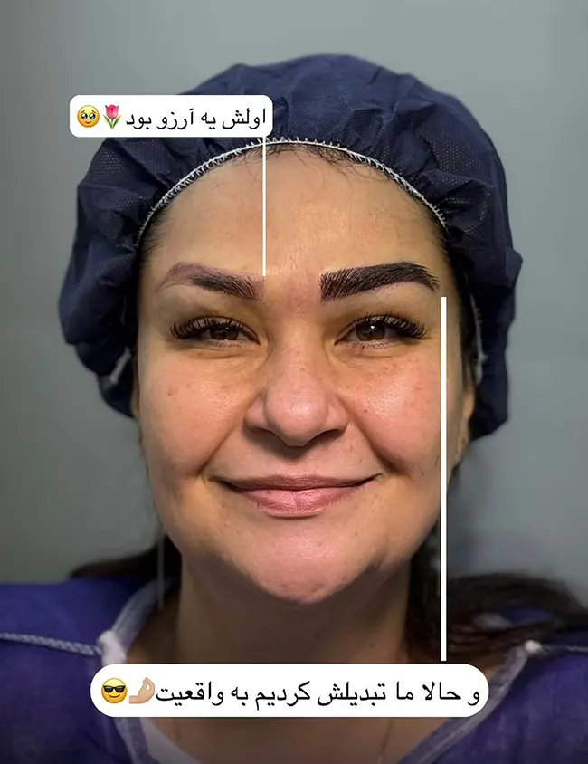 کاشت ابرو 