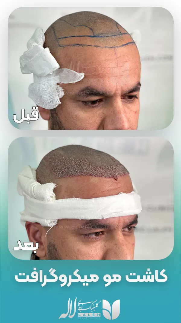 کاشت مو به روش میکروگرافت