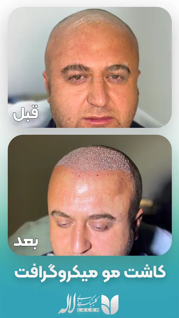 کاشت مو به روش میکروگرافت قبل و بعد