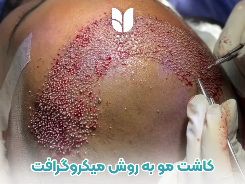 کاشت مو به روش میکروگرافت