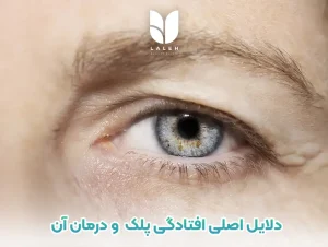 افتادگی پلک