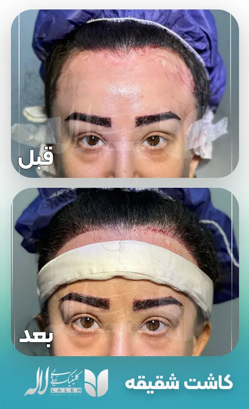 کاشت شقیقه