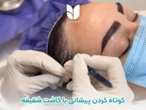 کوتاه کردن پیشانی با کاشت شقیقه
