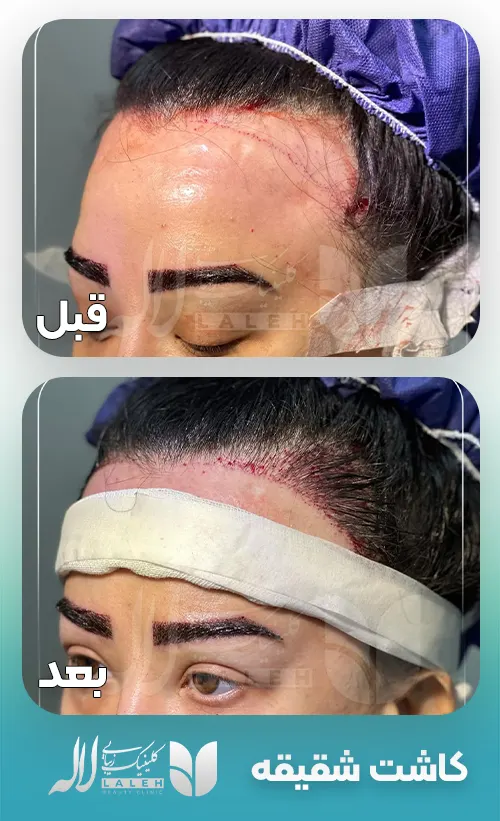 کاشت شقیقه
