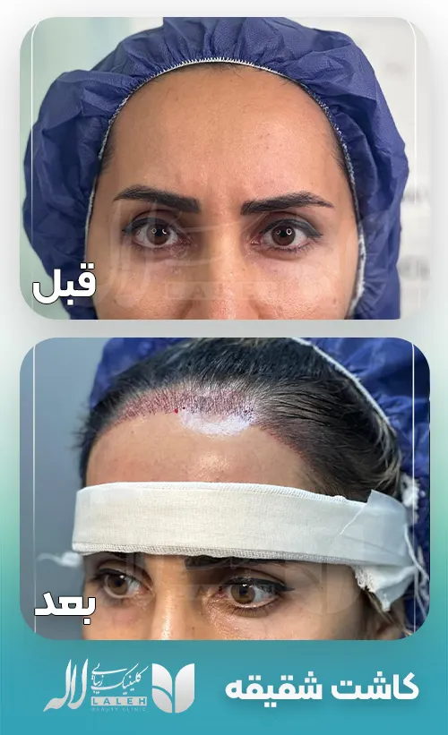 کاشت شقیقه