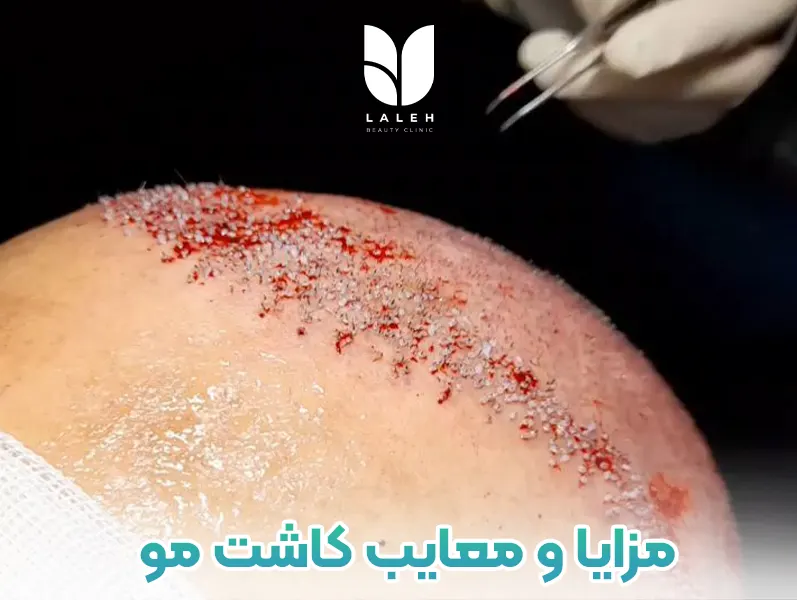 مزایا و معایب کاشت مو