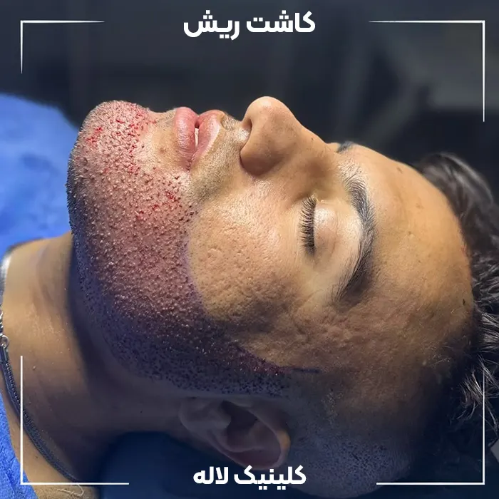کاشت ریش