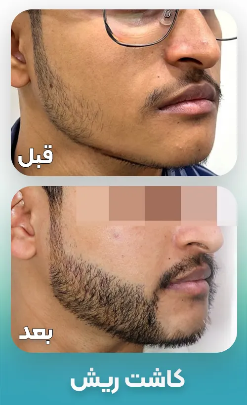 کاشت ریش