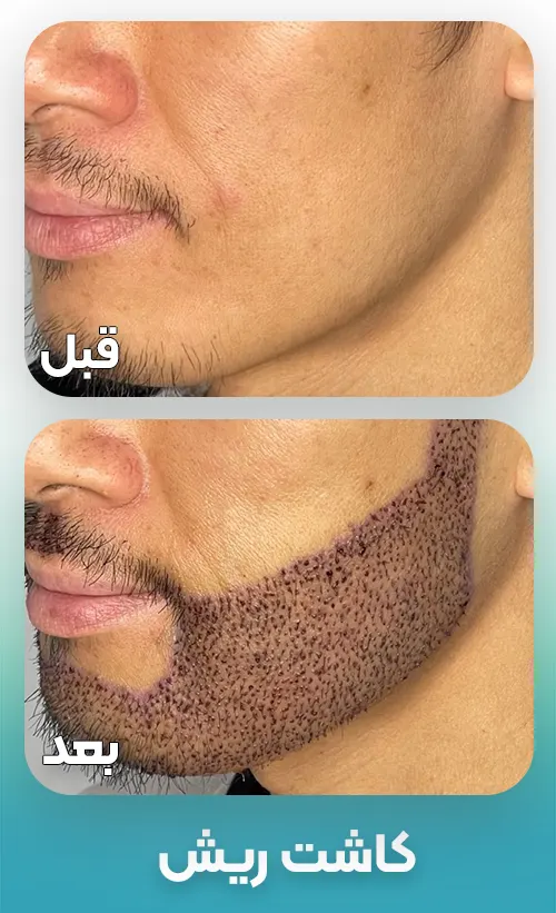 کاشت ریش