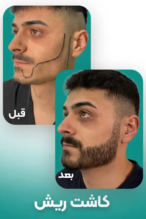 کاشت ریش