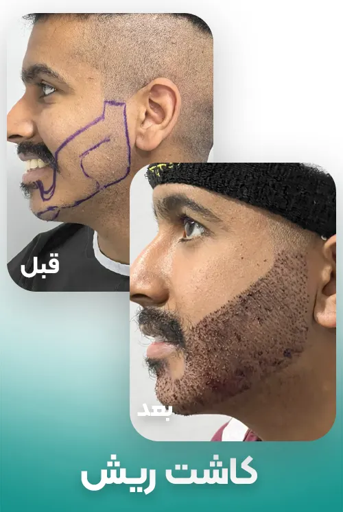 کاشت ریش