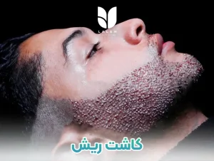 کاشت ریش