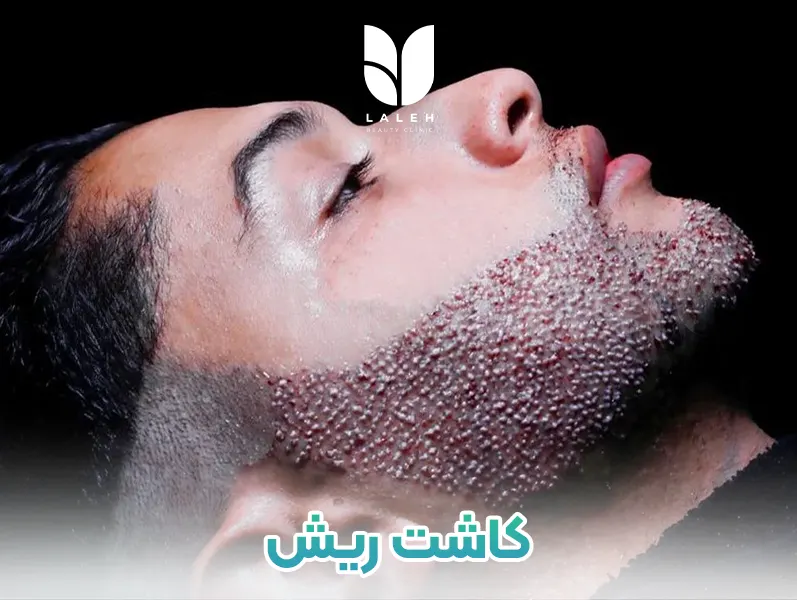 کاشت ریش