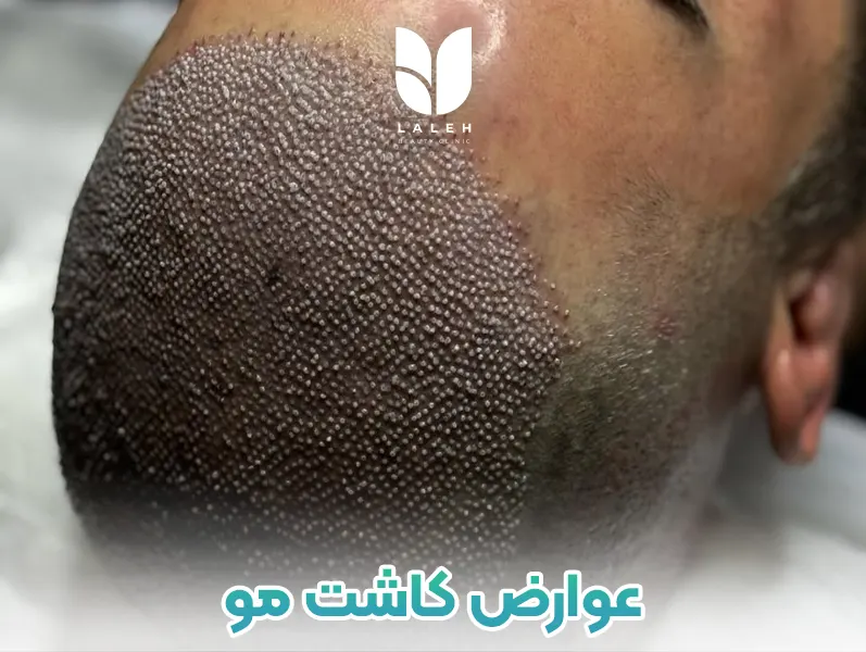 عوارض کاشت مو 