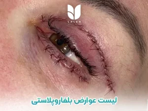 عوارض بلفاروپلاستی