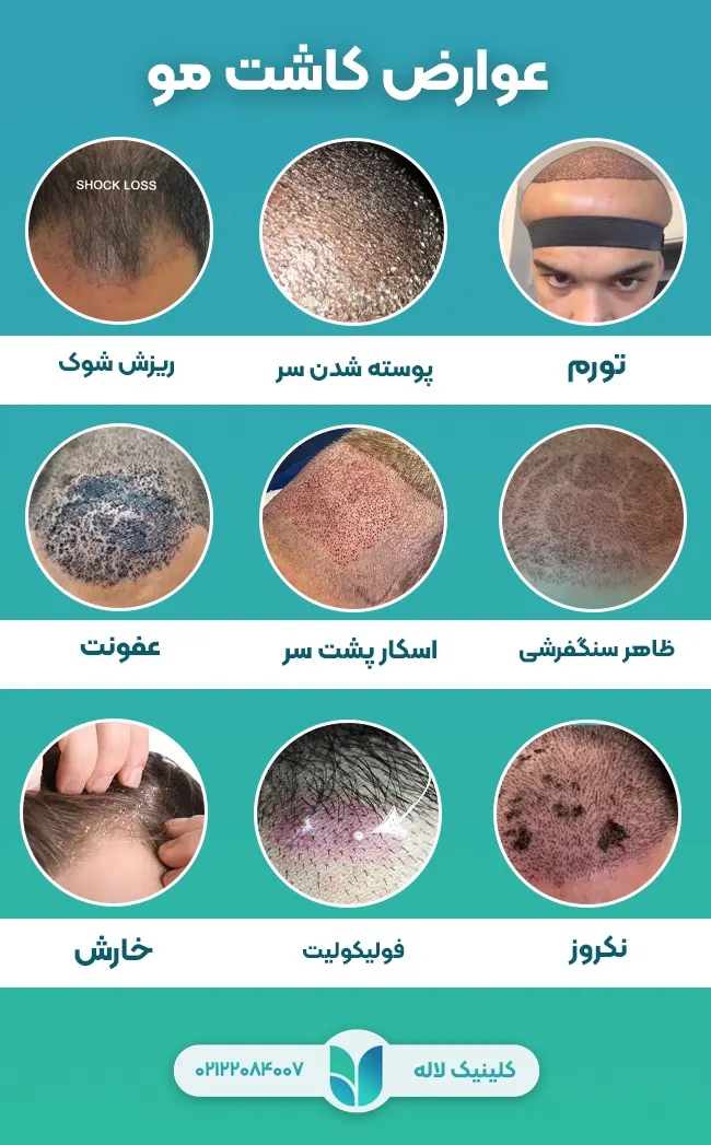 عوارض کاشت مو 