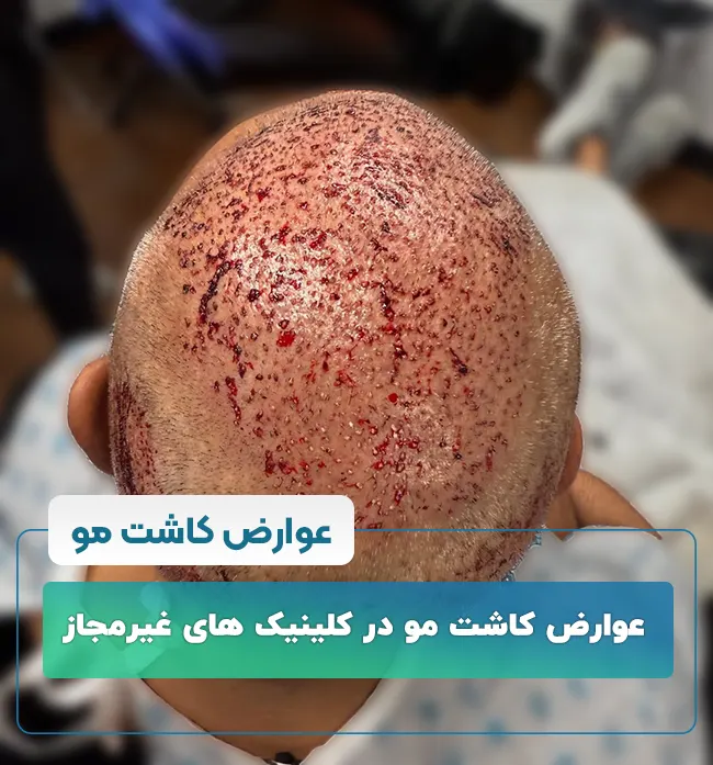 عوارض کاشت مو 
