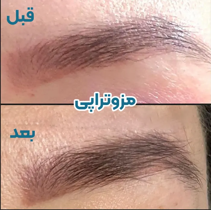 قبل و بعد مزوتراپی ابرو
