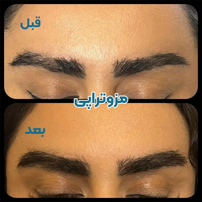 قبل و بعد مزوتراپی ابرو