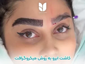 کاشت ابرو به روش میکروگرافت