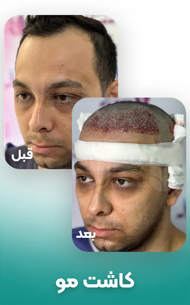 کاشت مو