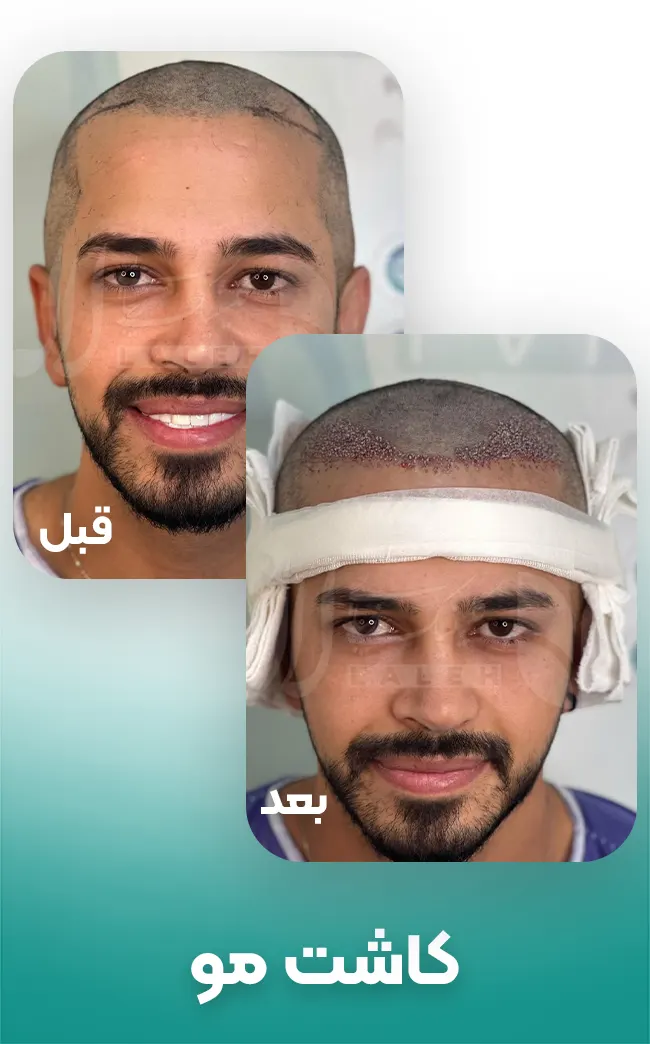 کاشت مو