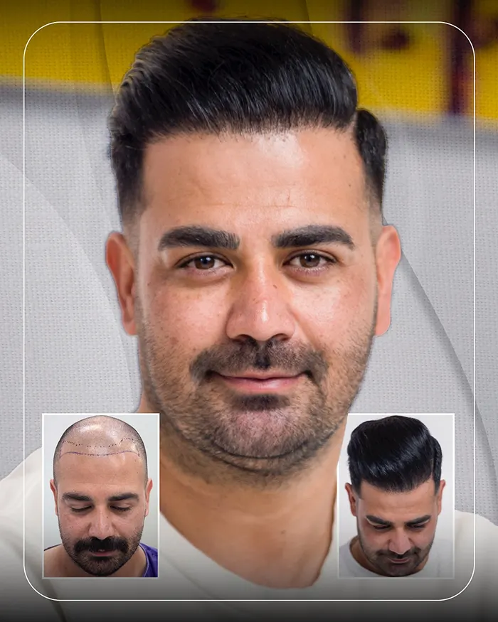 کاشت مو