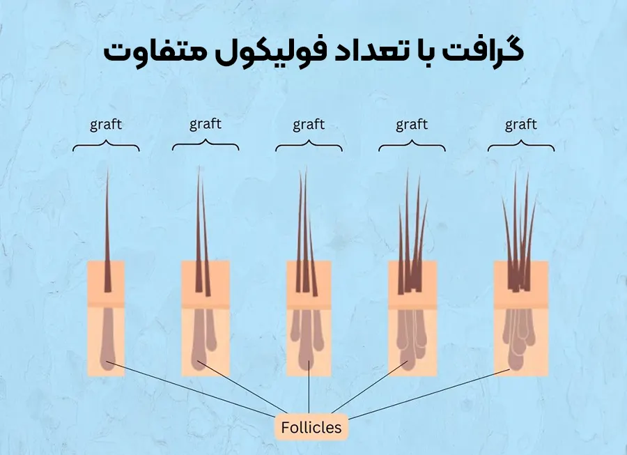 گرافت مو
