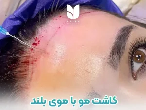 کاشت مو با موی بلند