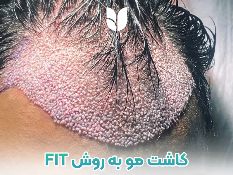 کاشت مو به روش FIT