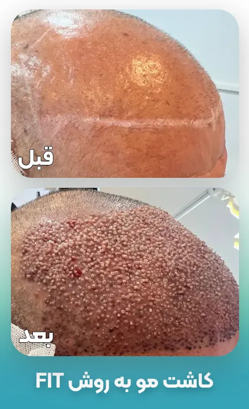 کاشت مو به روش FIT