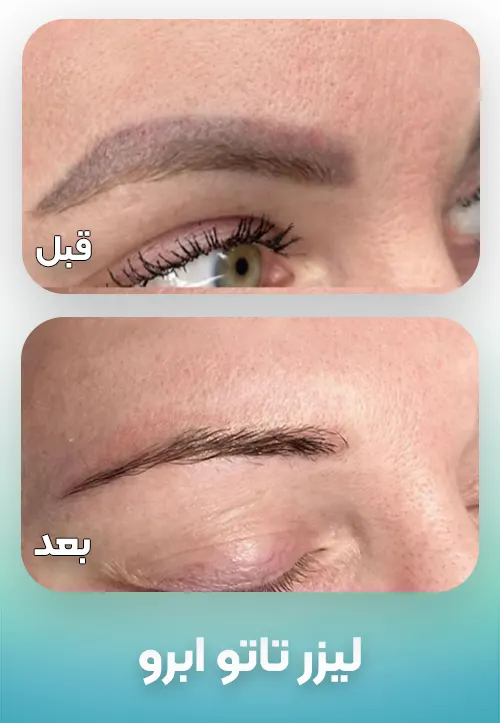 پاک کردن تاتو ابرو با لیزر