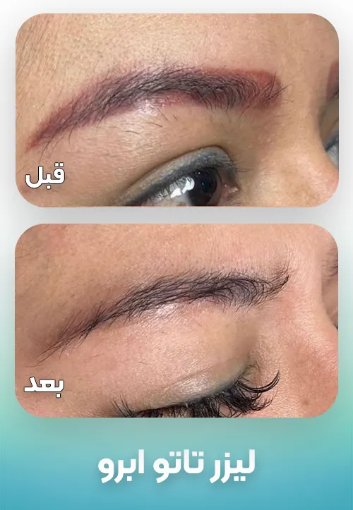 پاک کردن تاتو ابرو با لیزر