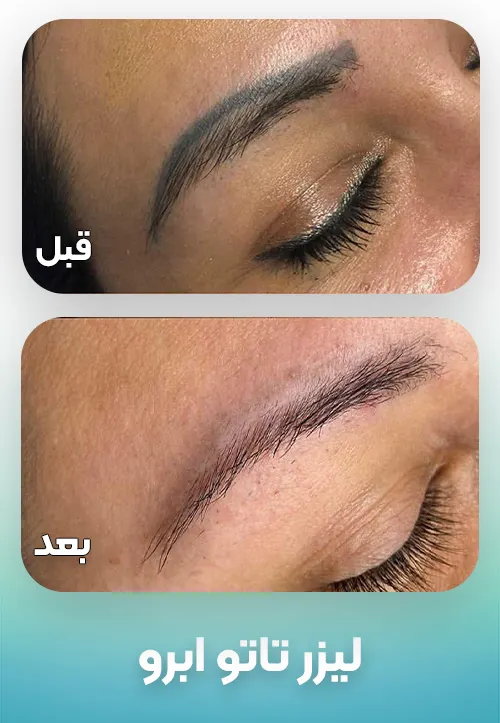 پاک کردن تاتو ابرو با لیزر