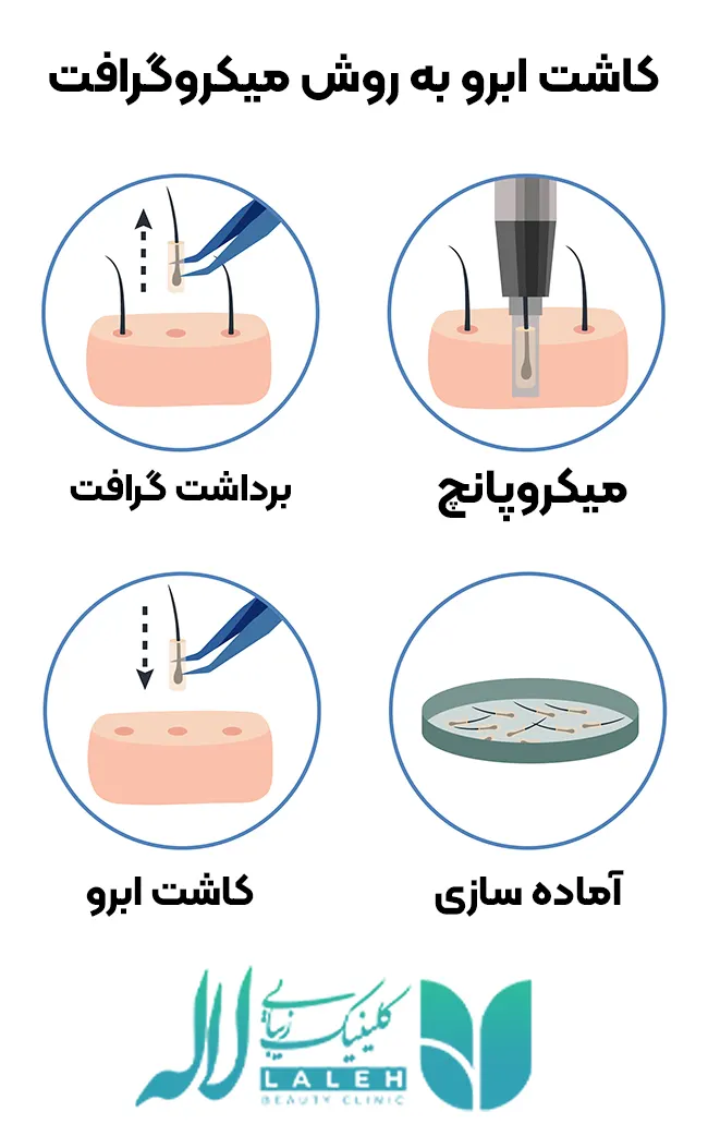 کاشت ابرو به روش میکروگرافت