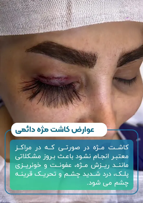 عوارض کاشت مژه دائمی