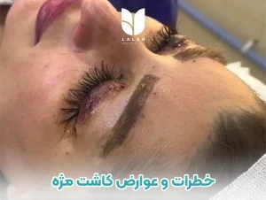 خطرات و عوارض کاشت مژه