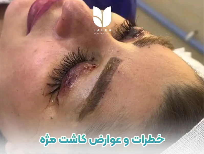 خطرات و عوارض کاشت مژه
