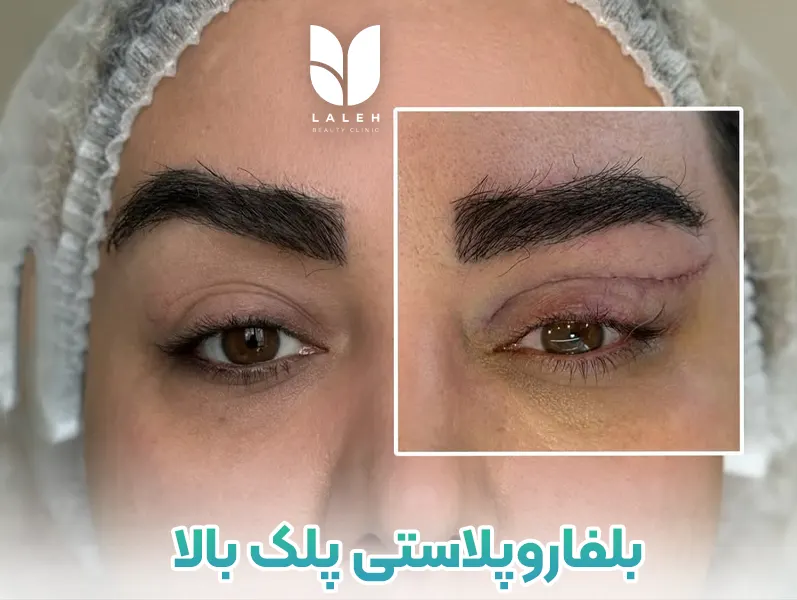 بلفاروپلاستی پلک بالا