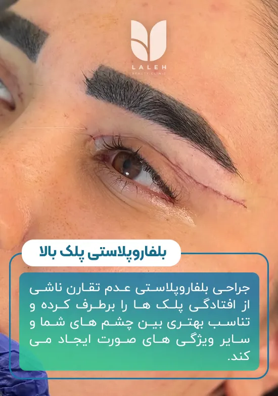 بلفاروپلاستی پلک بالا