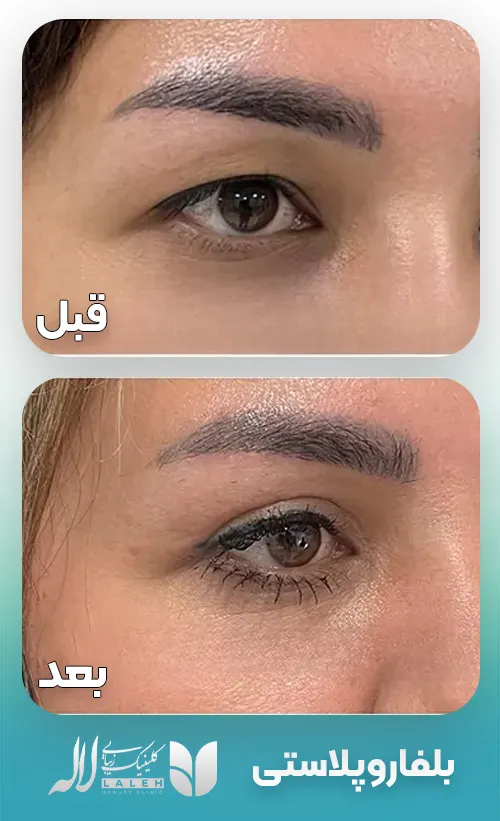 بلفاروپلاستی پلک بالا