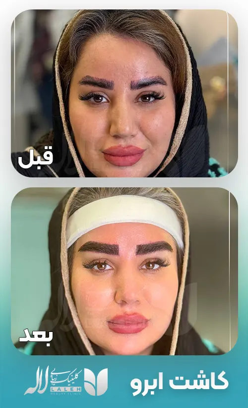 کاشت ابرو