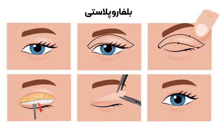 بلفاروپلاستی